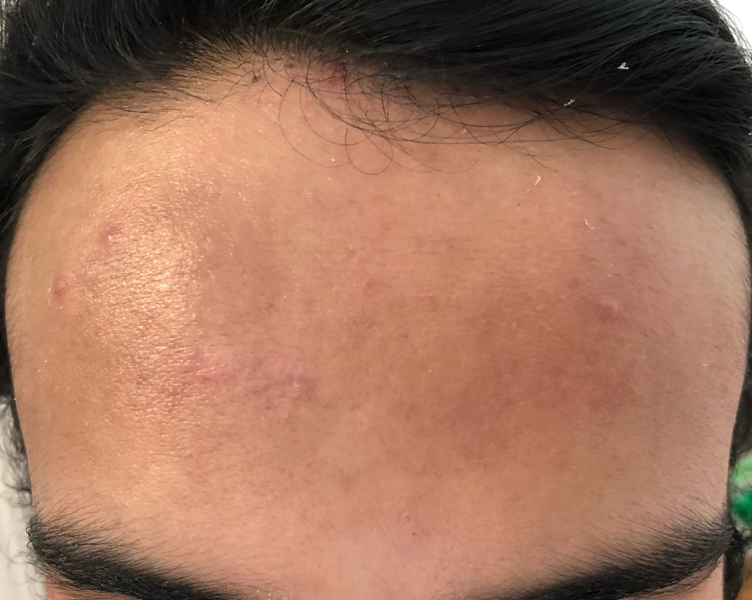 Casos de Acné - Antes y Después de Peelings